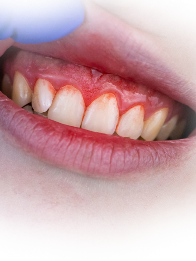 Common causes of gum disease