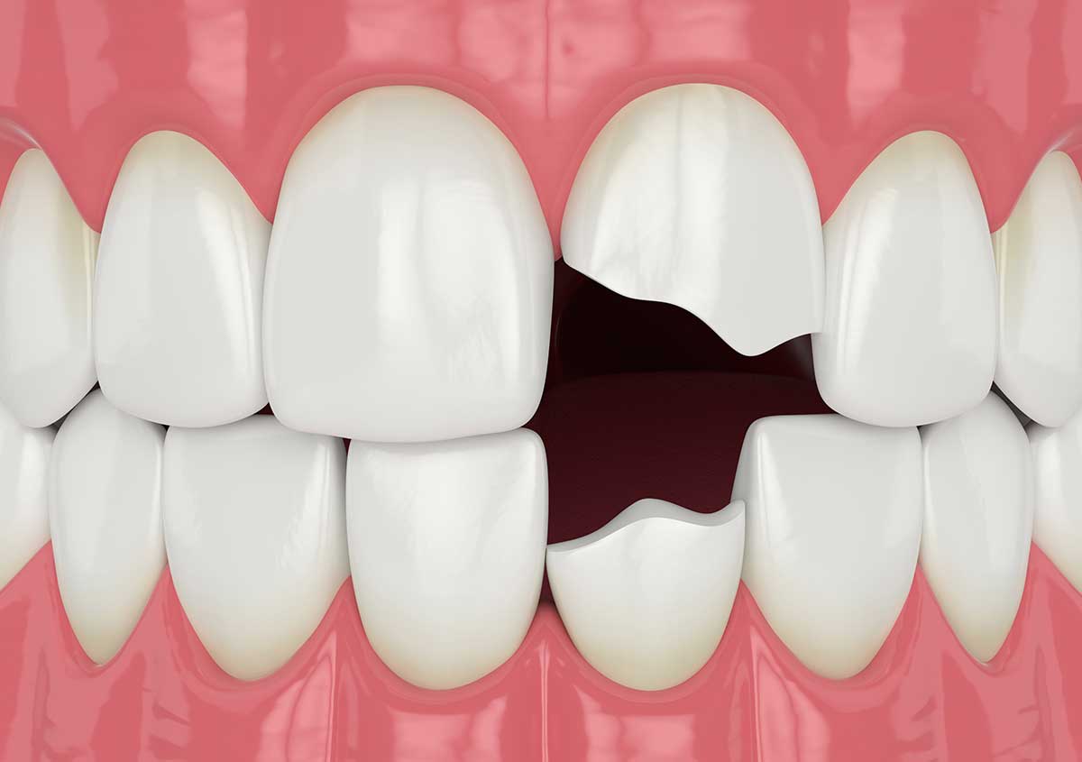 3D render of jaw with broken incisors teeth