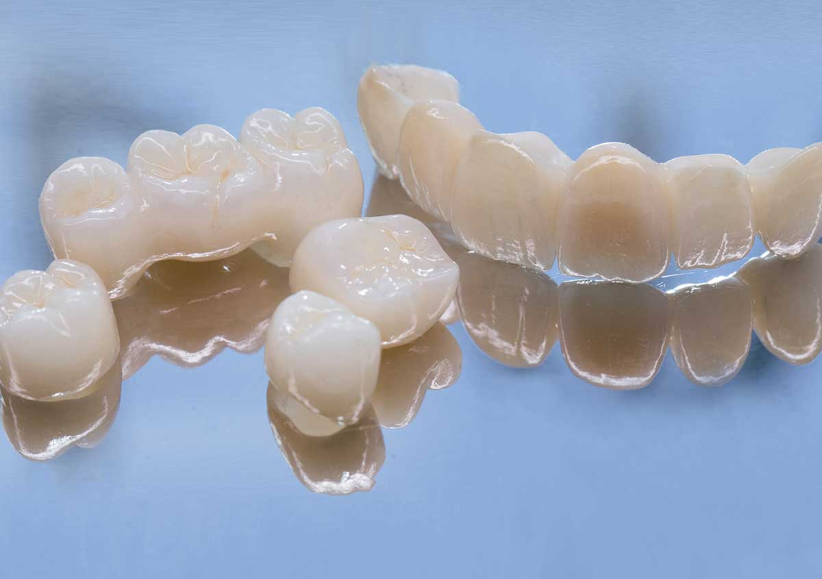 Metal Free Ceramic Dental Crowns. Ceramic zirconium in final version. Staining and glazing. Precision design and high quality materials