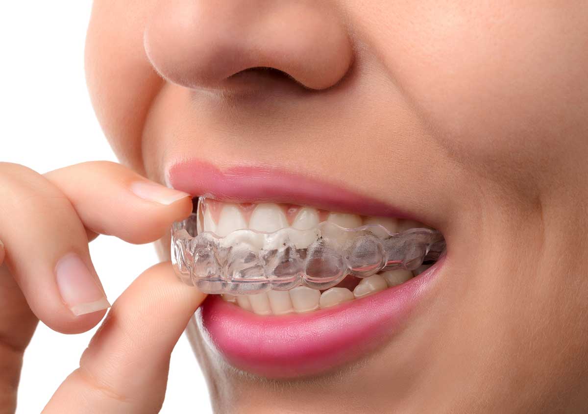 Secrets Revealed About Teeth Straightening – With Invisalign
